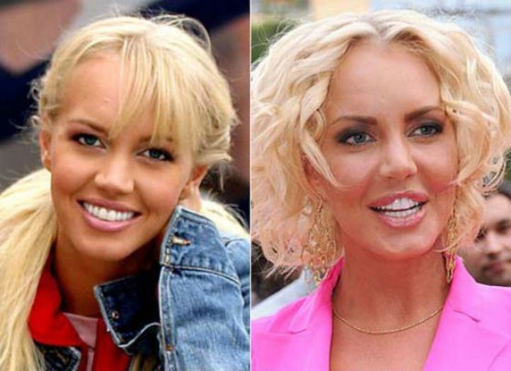30 фото знаменитостей до и после пластических операций