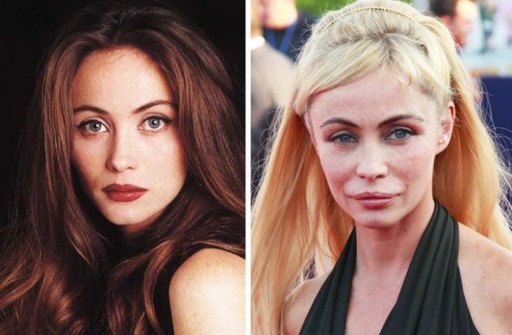30 фото знаменитостей до и после пластических операций